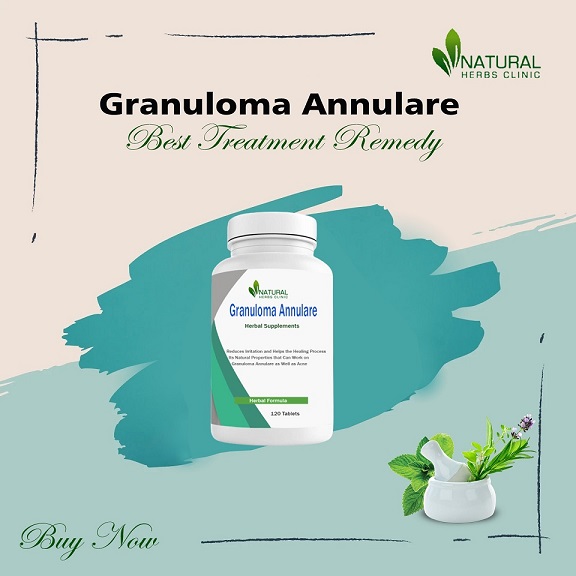 Granuloma Annulare Relief Methods: Navigating the Best Solutions to Control the Symptoms